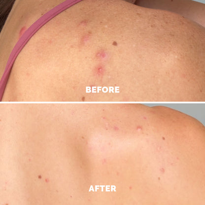 Blemish Control Face &amp; Body Mist